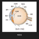 당뇨합병증 당뇨망막병증 원인과 증상 이미지