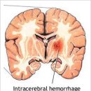 Intraparenchymal hemorrhage ICH 이미지