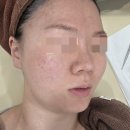 김포 구래동 리프팅 l 살롱드치유 여드름압출 8년단골 찐인증