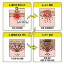 기흥vitro | 세렉소 시술 전 꼭 알아야 할 색소침착 진실과 개선 솔루션
