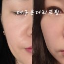 대구 | 내돈내산 동성로피부과 대구온다리프팅 후기