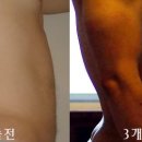 Re: 남자 복부와 가슴 지방흡입 시술 이미지