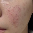 내성한의원 | 부산여드름흉터한의원에서 새살침 4회차 받은 후기 <내돈내산>