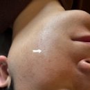 대세한의원 | [여드름 흉터치료 후기 2편] 분당 한의원 새살침 치료 1차수 후기 (내돈내산)
