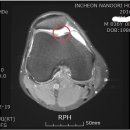 부상 문의 무릎 우측 슬관절 연골 손상 이미지