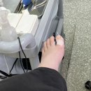 내손톱내발톱 | 제발 내 인생에서 꺼져 내성발톱! 내돈내산 교정 후기_첫 번째 교정 시작