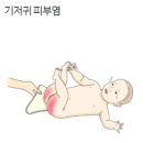 아기 피부/미용/성형 질환 기저귀 피부염 이미지