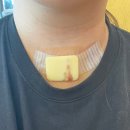 성대천사약국 | [갑상선암 투병일기] 8️⃣갑상선암 수술 후 요양생활 (수술 후 2주까지 회복 정도)