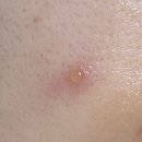 남대구약국 | 볼에 갑자기 수포, 물집🥹 피부과 전문의 병원간 후기 &amp; 약국약(화상X, 벌레X)