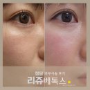 청담제이더마의원 | 피부시술 추천 가격 저렴한 리쥬란 쥬베룩 물광 리쥬베톡스 모공 잔주름