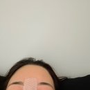 온솔약국 | 코수술 당일~12일차 후기 (자가늑+실리콘) 붓기, 통증 솔직 후기