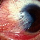 Pterygium (eye) 이미지