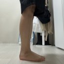 핏메드 | 🦵 압구정 종아리보톡스 고민 끝! 압구정로데오 피부과 하체 지방분해주사 + 바쿠메드 순환관리 후기