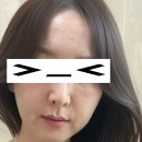 바노바기의원 | 바노바기의원 창원 리쥬란 힐러 솔직 후기 (엠보, 통증, 가격)