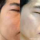 럭셔리뷰티 김포 | 가양역 피부과 효과 좋았던 포텐자 가격 및 통증 후기