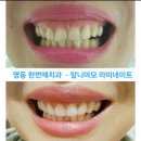 마모 심한 사람 라미네이트 후기 - 명동 한번에치과