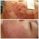 뷰엘마켓 | 성장기여드름,청소년여드름내돈내산 홈케어 여드름고치는방법^^리뉴얼파이토신