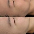 (주)스톤소프트 | 동탄웨딩관리 트러블관리 약초필링으로 꿀피부 된 후기