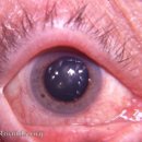 각막염[keratitis] 이미지