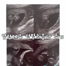 홍산의원 | 임신22주 정밀초음파 후기 (마포 신홍산부인과)