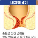 건항외과의원 | 광명,철산 치질, "참다가 결국..." 치핵 수술 결정기!!