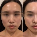 사림동308 | 창원사림동에스테틱 '서아에스테틱' 윤곽관리 후기