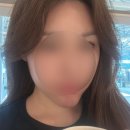 삼성얀의원 티타늄리프팅 2차 일주일 후기 내돈내산 (얼굴길이감 개선)