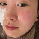 오라클피부과신인천 | 쥬베룩 3차 완주 후기! 1차 효과, 통증, 솔직 비교 (내돈내산 GIF)⁠