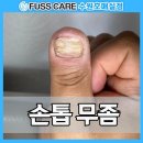 푸스케어 수원호매실점 | 빨래판 손톱, 손톱무좀 고민해결 푸스케어 수원호매실점