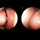 동춘당한의원 | "환절기마다 맑은코가 줄줄 흘러요. 눈도 가렵고" - 40대 남성 비염 첩약건강보험 치료 사례