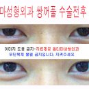 쌍꺼풀수술전후사진-눈성형,안검하수 후 눈매교정술 쌍커플 수술사진첨부 이미지