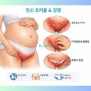 비엘왁싱(BL waxing) | [천안 두정동]예민한 초산, 브라질리언 왁싱은 안전한 ‘임산부 왁싱 전문’ 비엘뷰티에서