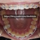 연세참예쁜치과교정과치과의원 | [연세참예쁜치과] 동탄치과상담 앞니 부분교정 동탄교정후기 4 (앞니 틀어짐, 과개교합)