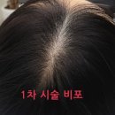 군자smp 헤어라인 정수리를 자연스럽고 풍성하게 사월에스튜디오 2차 리터치 후기