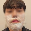 하상한방병원 | 대구시지 수성구피부과, 남자레이저제모 젠틀맥스프로플러스 1차 효과후기