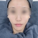 엘라스틴신사역점 | 신사역피부과 볼뉴머 600샷 내돈내산 후기 박서준 고주파 리프팅
