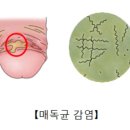[비뇨의학 정보] 매독👿 (STD/syphilis/트레포네마팔리듐/RPR/VDRL/FTAABS/페니실린)