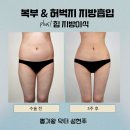 유주왕외과의원 | 허벅지안쪽지방흡입, 살은 빠졌는데 라인이 달라지는 진짜 이유