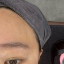 클림의원 | 명동 눈썹문신제거 1회차 내돈내산 후기 “클림의원 명동점”