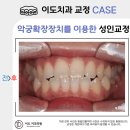 보람프라자 좌측 공한지 앞 | 나성동교정잘하는치과가 알려주는 교정의 핵심 악궁확장