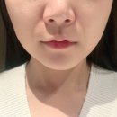 엑셀고급 | 엑셀웨이브 리프팅 내돈내산 후기 ㅣ 선릉역피부과 추천