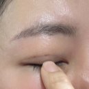 (주)에이티 | 내돈내산 쌍꺼풀 수술 후기 (3)｜2-3주차 붓기와 술｜무쌍 비절개 매몰｜쌍수 후 운동