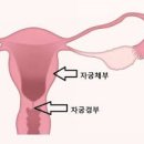 자궁경부암 초기 증상 원인 이형성증 검사 방법 예방접종 오진 확률 이미지