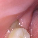 이미지치과의원 | 오리역 치과 추천｜리볼리치과의원 사랑니 발치 후기 (겁쟁이도 무사 통과)