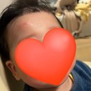 달성2차3로 | 아기 두상 헬멧 착용 7주 후기 | 2차 수정 &amp; 하루 20시간 착용 도전기