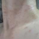 [카푸치노의 글쓰기]얼굴과 목 부위에 난 쥐젖과 비립종 제거 익산&lt;실면도&gt; 받은 후기