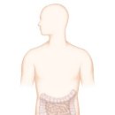 장예항 | 치루 (anal fistula)