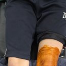 유어타임성형외과의원 | [유어타임 보험진료 근황] 무릎도 보이는 부분입니다. 성형외과를 찾으세요 ^^