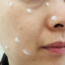 동산라벨라의원 | 점 빼고 관리, 점 제거 가격, 후기