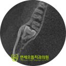 으뜸치과의원 | [분당치과] 깨지고 나서야 안 인접면 충치의 진행속도, 보존과와 구강외과 전문의 협진을 통한 치료 후기